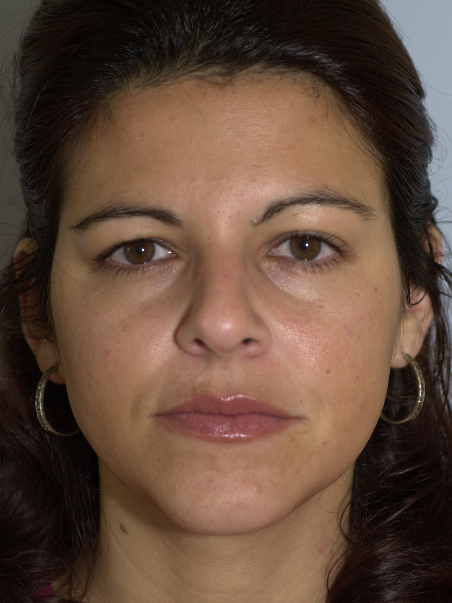 Case--6215 | After Face 1