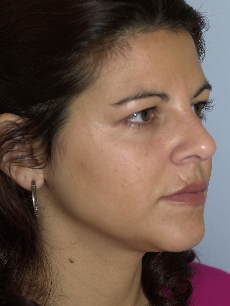 Case--6215 | After Face 2