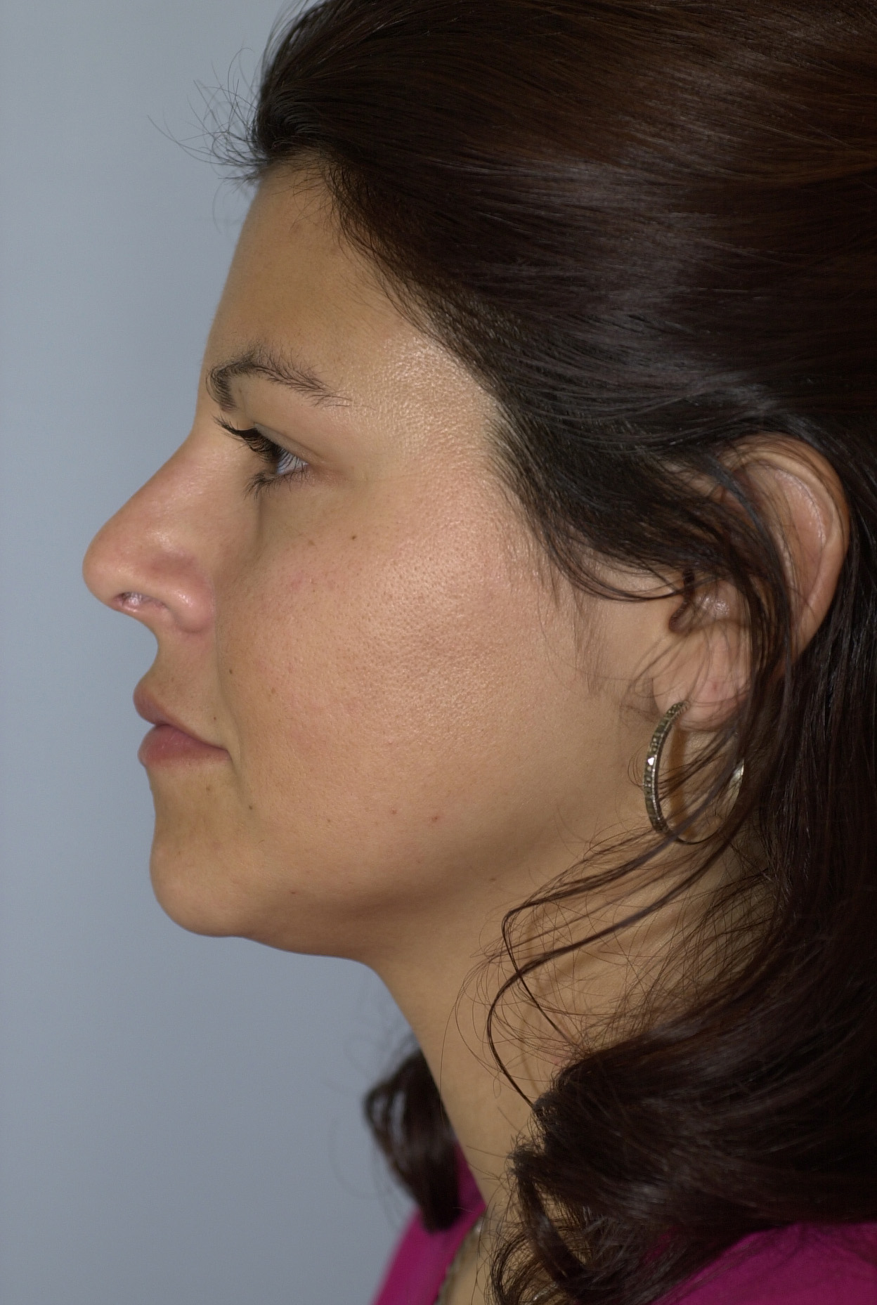 Case--6215 | After Face 5