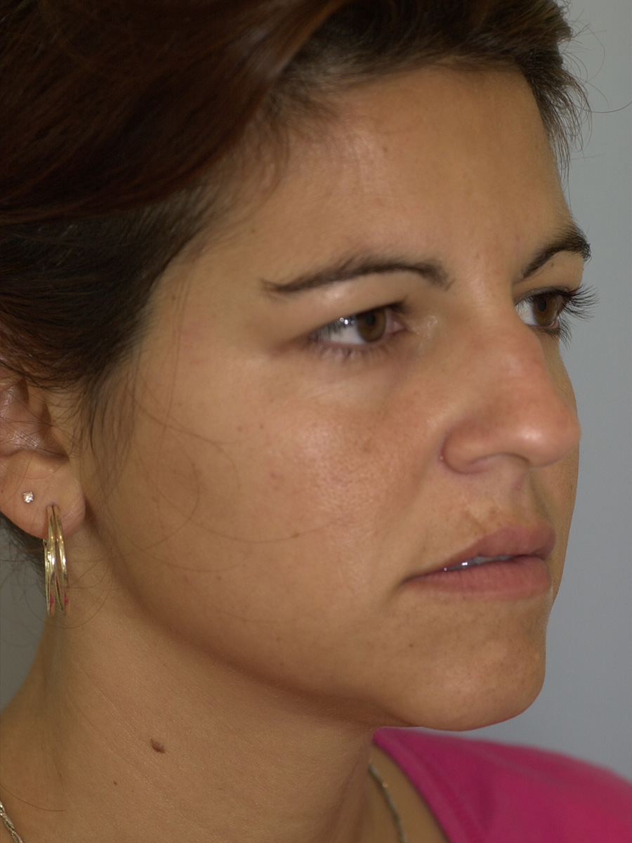 Case--6215 | Before Face 2