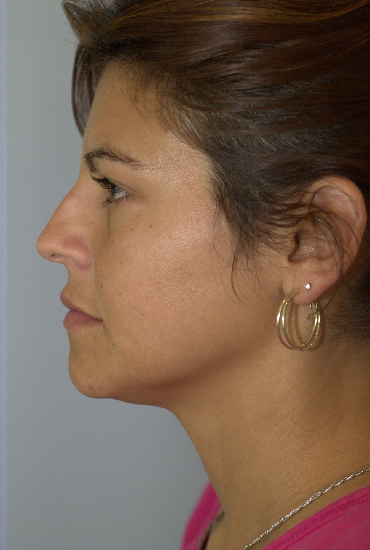 Case--6215 | Before Face 5