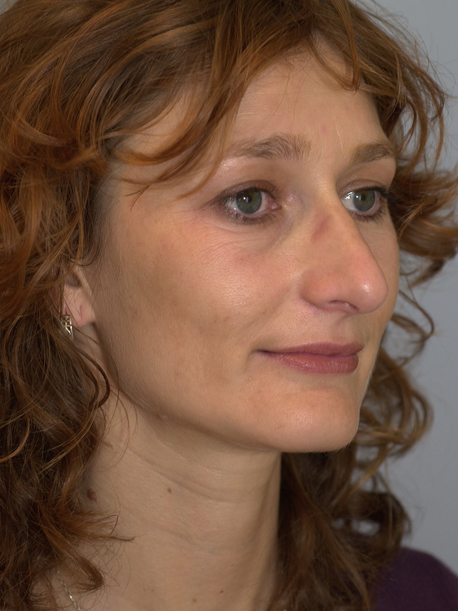 Case--4302 | After Face 2