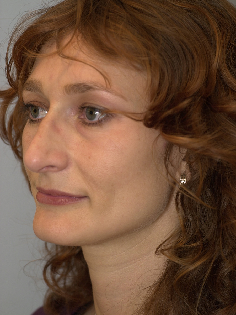 Case--4302 | After Face 3