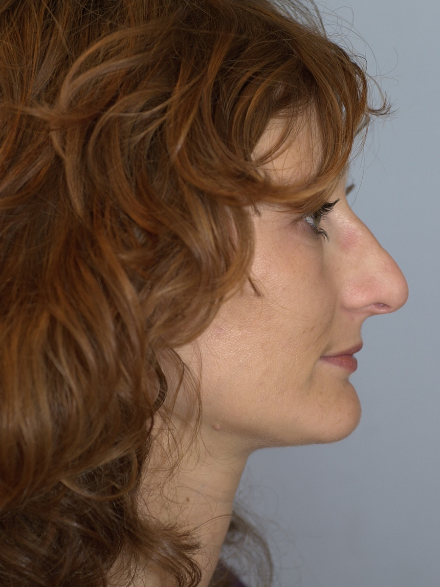 Case--4302 | After Face 4