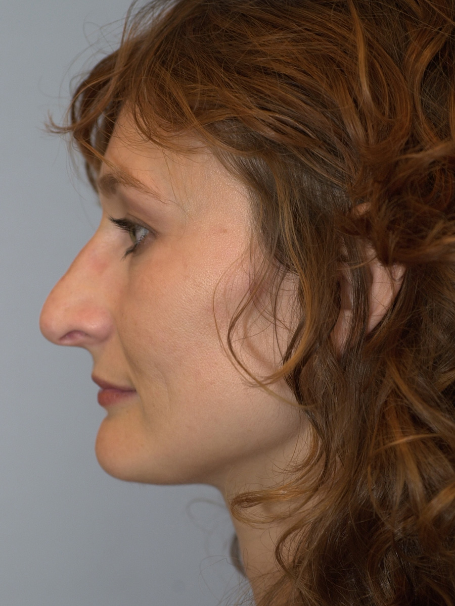 Case--4302 | After Face 5