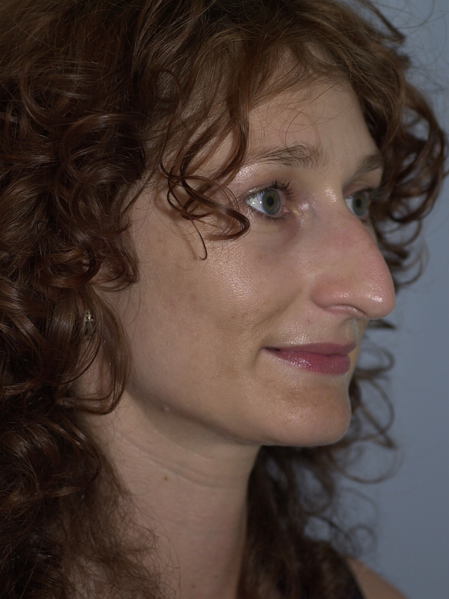 Case--4302 | Before Face 2