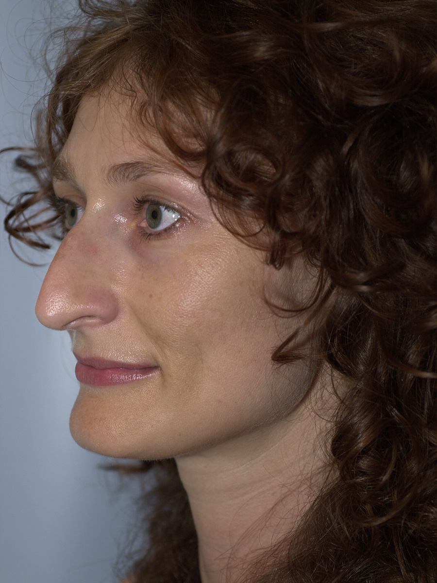 Case--4302 | Before Face 3