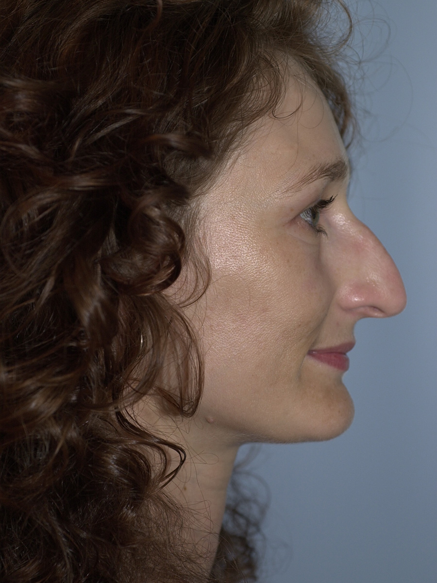 Case--4302 | Before Face 4