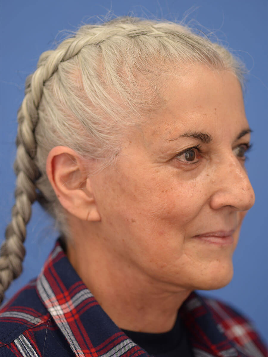 Case--2235 | After Face 5