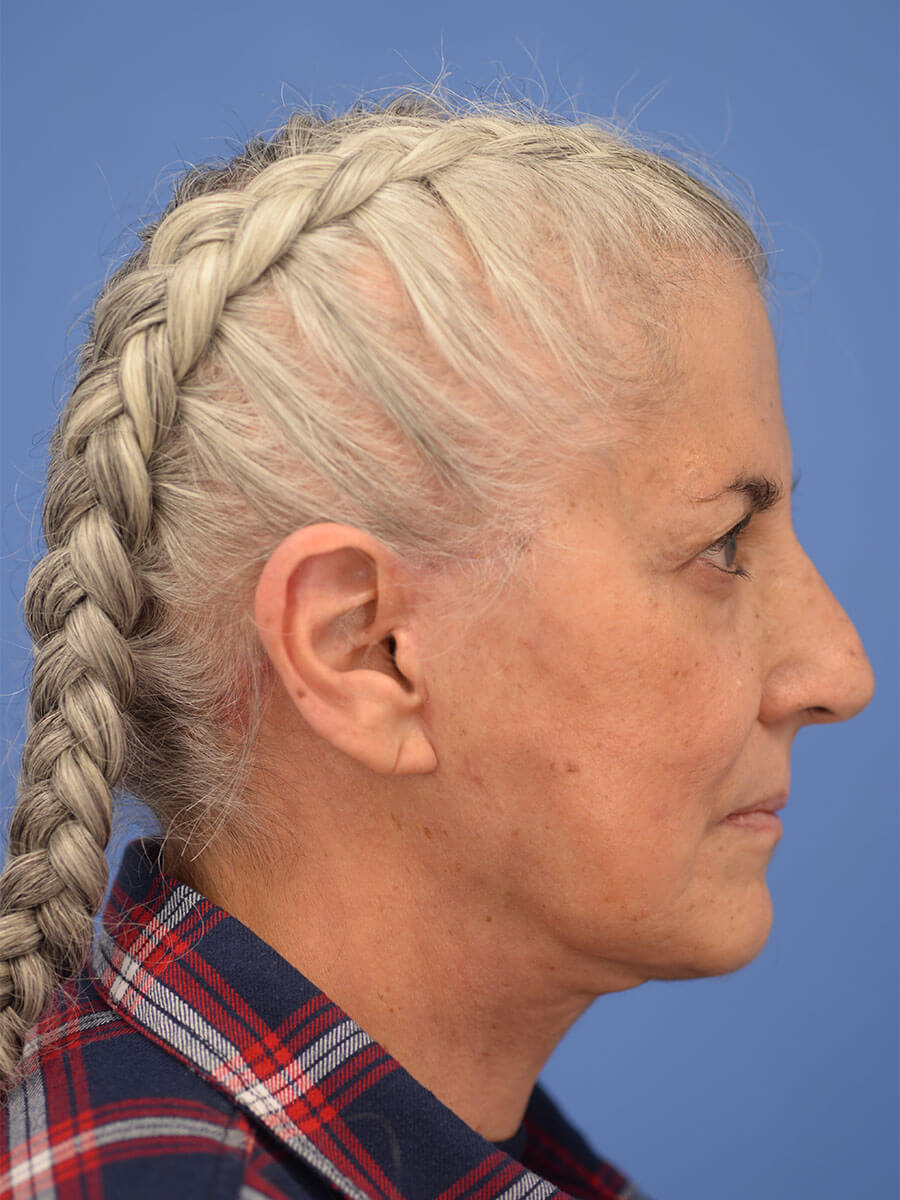 Case--2235 | After Face 3