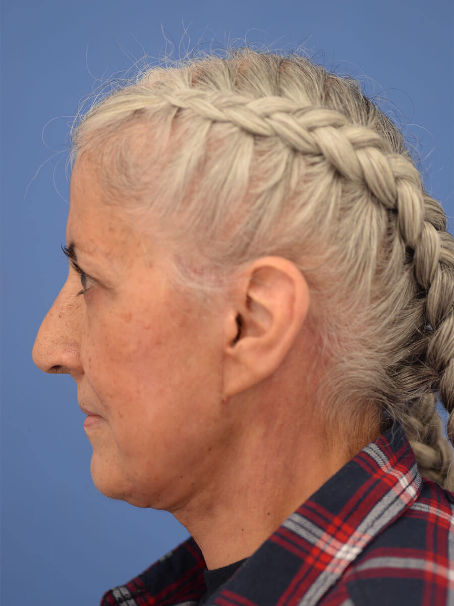 Case--2235 | After Face 2