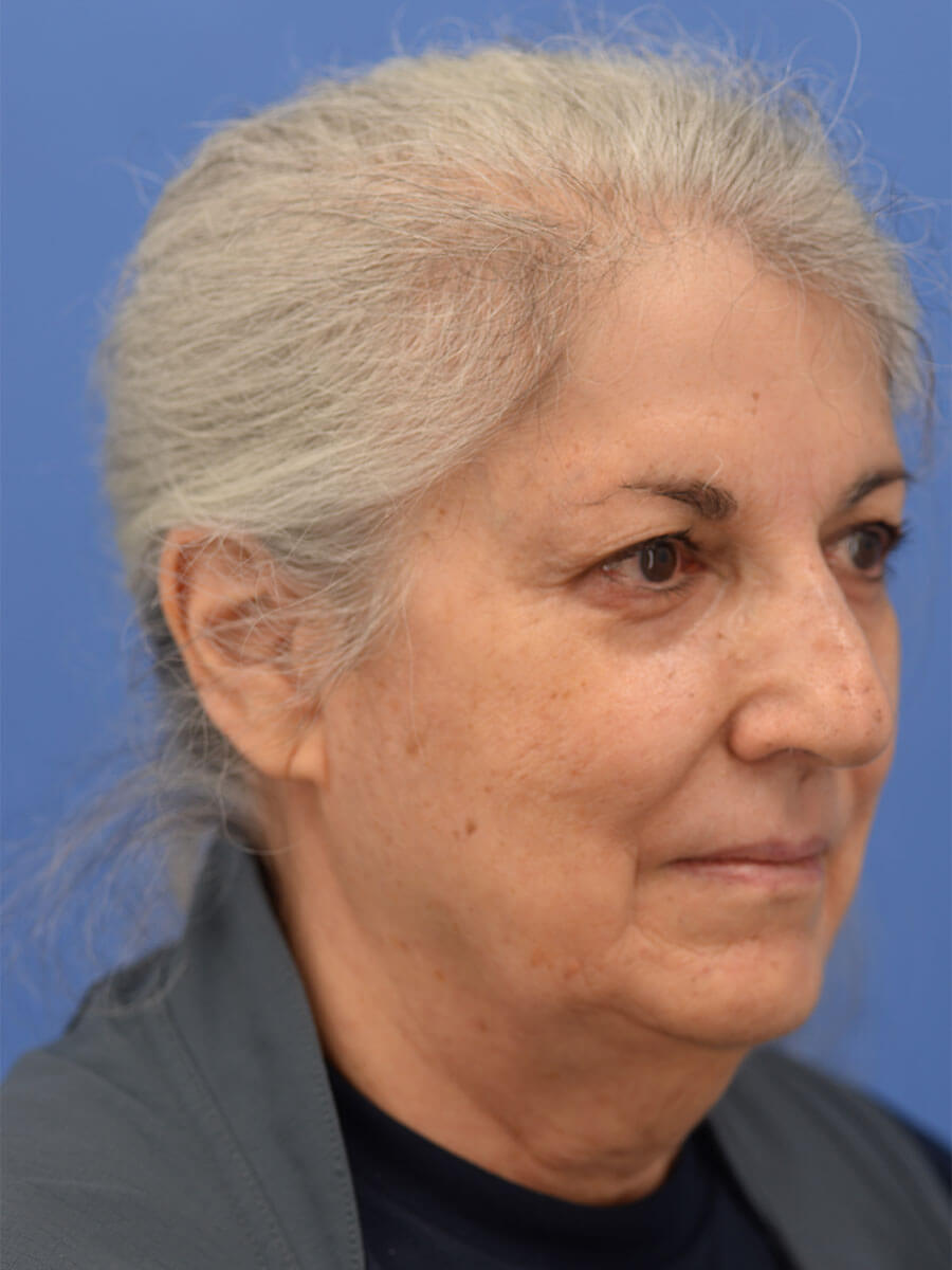 Case--2235 | Before Face 5