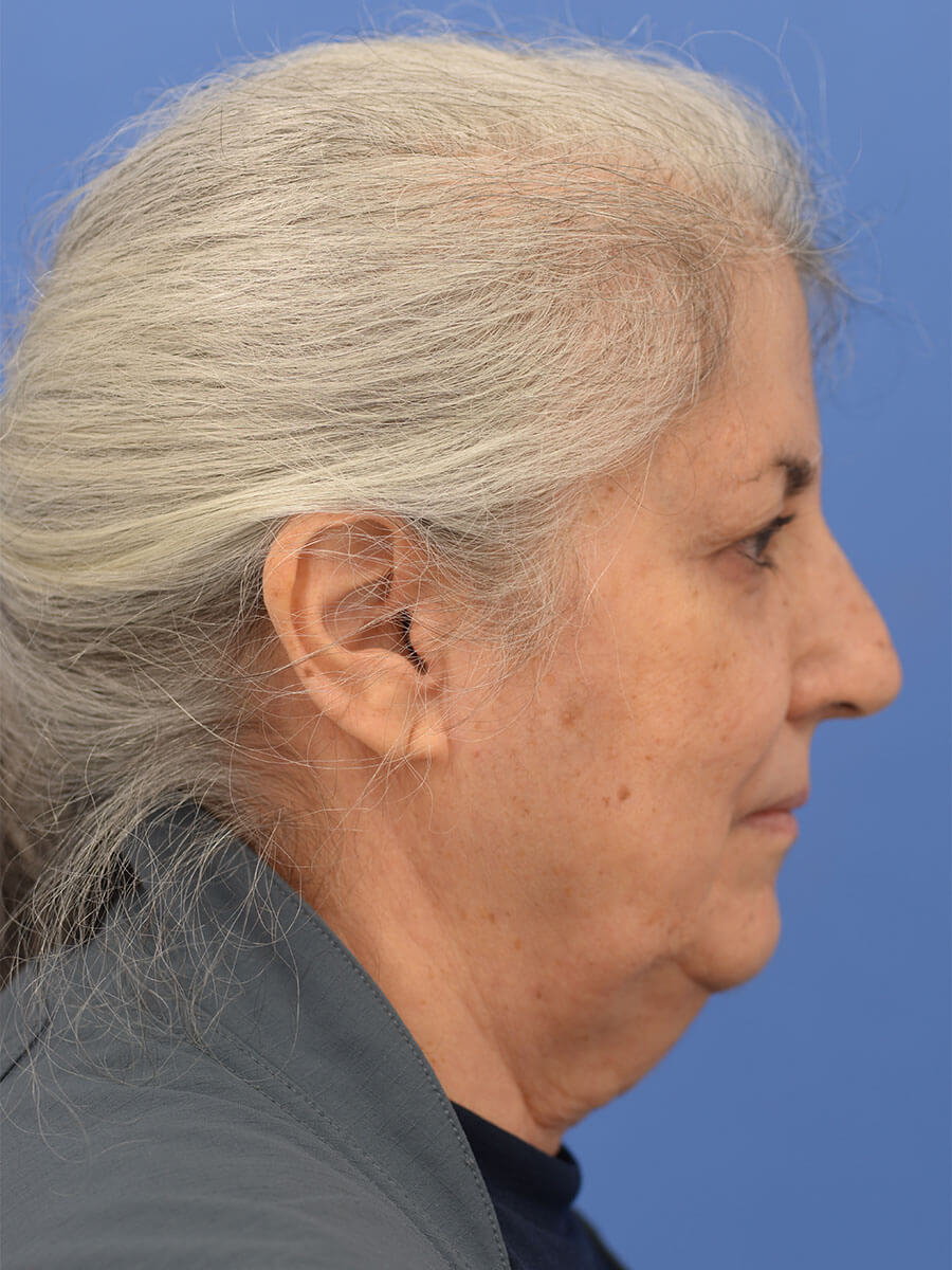 Case--2235 | Before Face 3