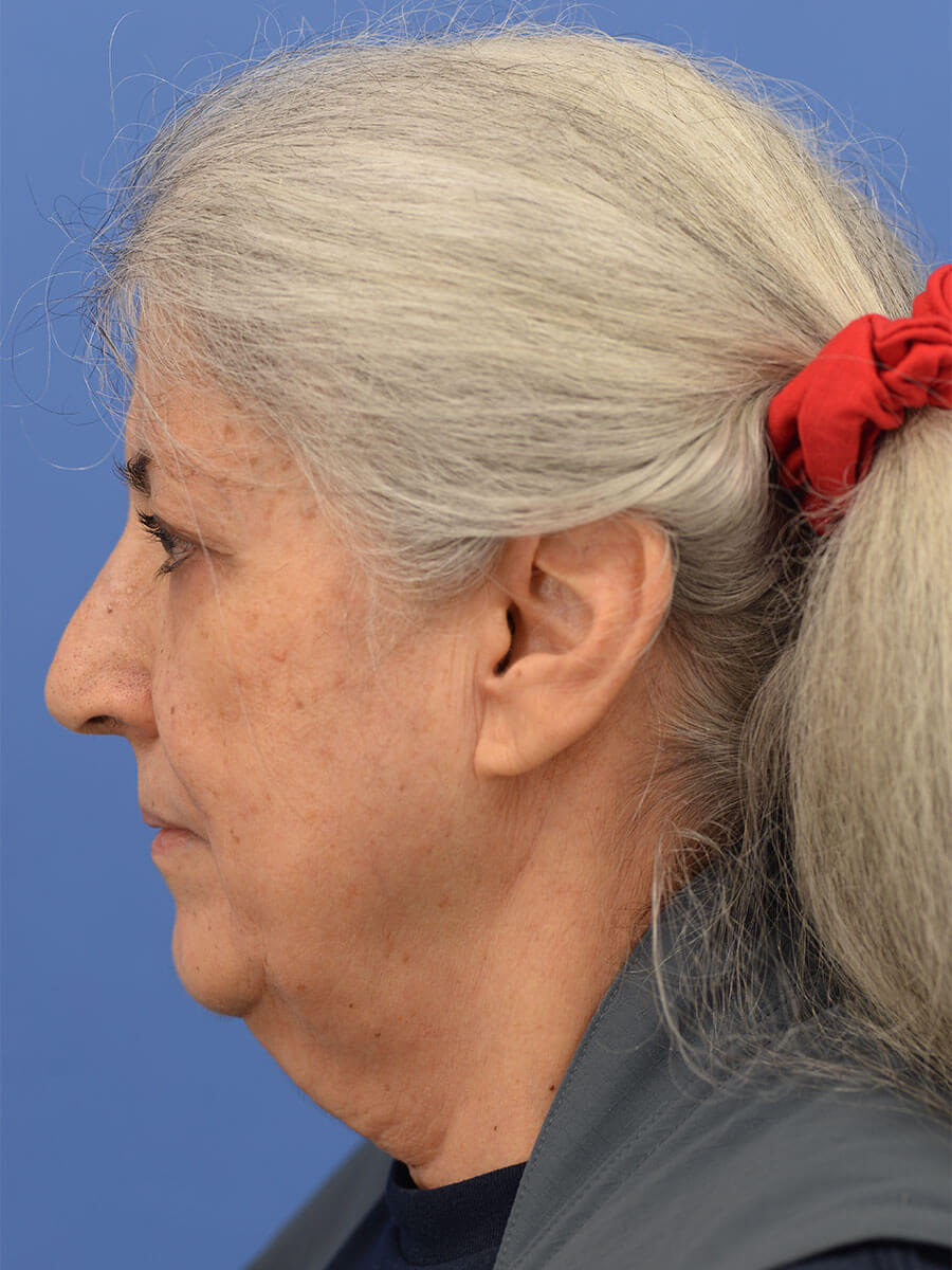 Case--2235 | Before Face 2