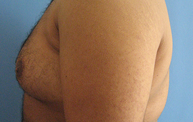 Case--6666 | Before Liposuction 4