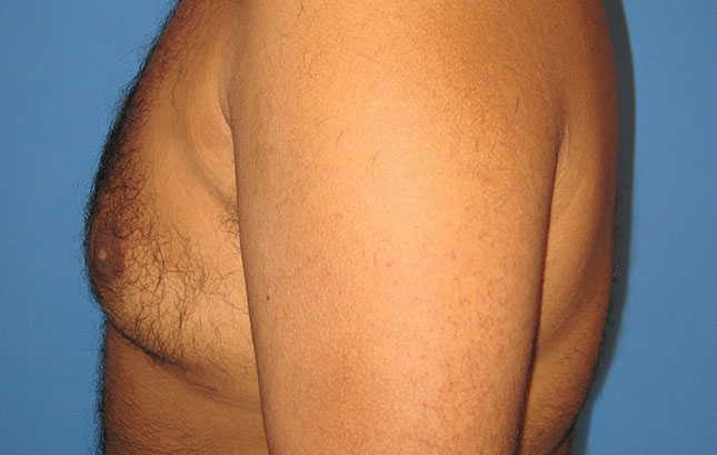 Case--6666 | After Liposuction 4