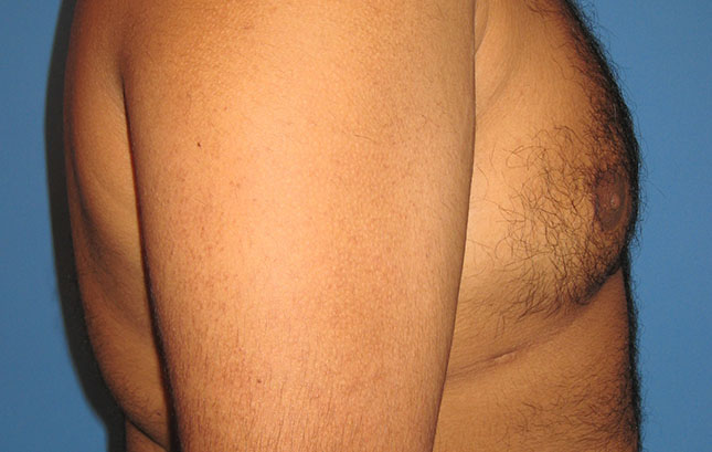 Case--6666 | After Liposuction 5