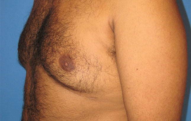 Case--6666 | After Liposuction 3