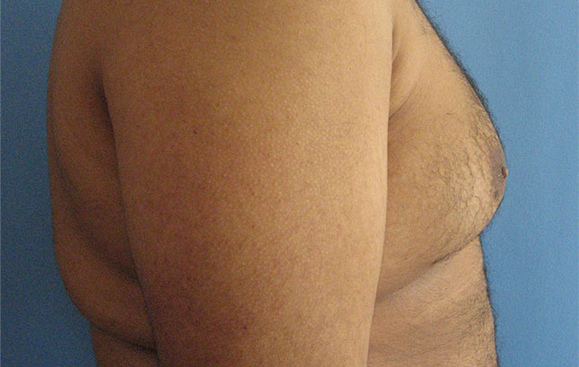 Case--6666 | Before Liposuction 5