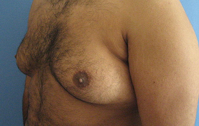 Case--6666 | Before Liposuction 3