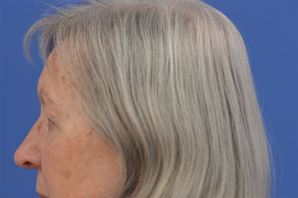 Case--2272 | Before Face 2