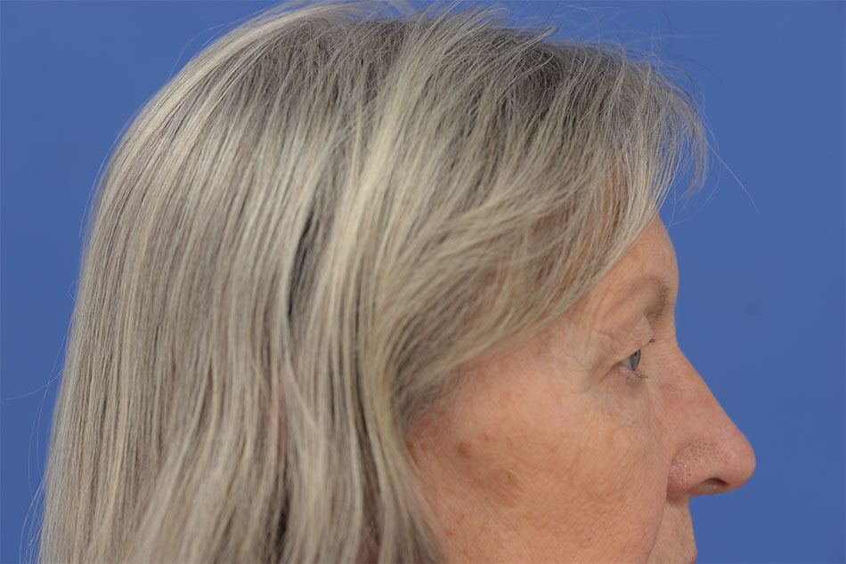 Case--2272 | Before Face 3