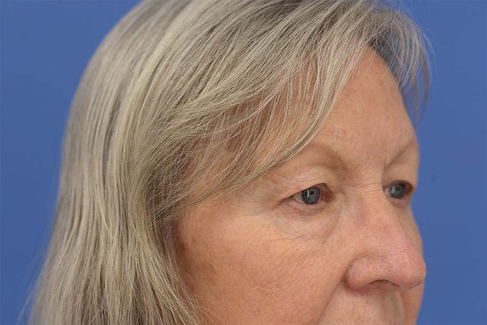 Case--2272 | Before Face 5