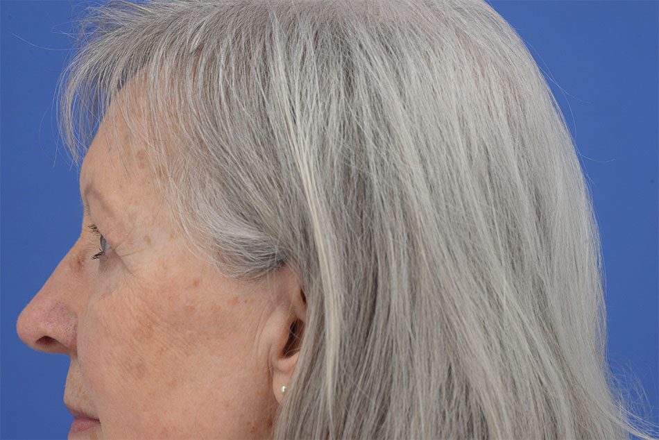 Case--2272 | After Face 2