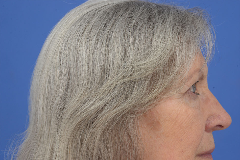 Case--2272 | After Face 3