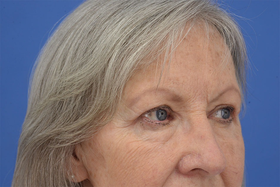 Case--2272 | After Face 5